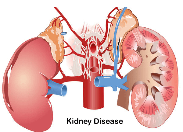 6-Kidney-Disease-1.png